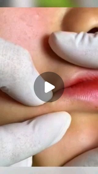 Pore Extraction Video, Pimple Pops Videos, Satisfying Pimple Pops, Pimple Pop, Lip Blackheads, Cystic Pimple Pop, Blackheads Popping Videos Nose, Black Heads, Pimple Removal Satisfying Videos