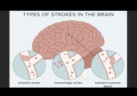 Different Types Of Strokes, Jaw Exercises, Types Of Strokes, Loss Of Balance, Nurse Study, Brain Facts, Medical School Studying, Med Surg, Medical Anatomy