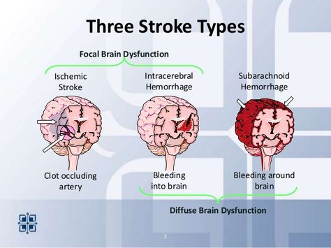 types of strokes | 2013.stroke areyouready Types Of Strokes Nursing, Emt Study, Types Of Strokes, Nurse Study, Nurse Study Notes, Cardiac Nursing, Medical Student Study, Nursing School Survival, Nursing School Studying