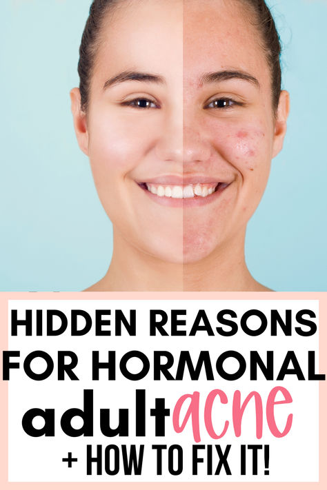 #acne #acnetreatment #naturalacnetreatment Prevent Acne Tips, Deep Acne Remedies, How To Get Rid Of Blemishes, Acne Breakout Chart, Makeup Ideas For Acne Skin, How To Help With Acne, Natural Remedies For Cystic Acne, Acne At Age 40, Bad Acne Remedies