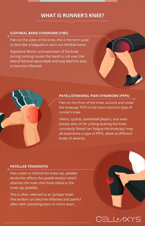 What is runner’s knee Knee Pain Relief Remedies, Vitamins For Nerves, Patellofemoral Pain Syndrome, Iliotibial Band, Swollen Knee, Runners Knee, Knee Problem, Pain Relief Remedies, Leg Cramps