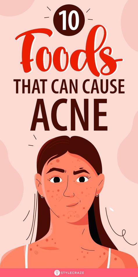 Good Face Wash For Acne Clear Skin, Bad Acne Pictures, Good Skin Tips Acne, Causes Of Pimples, Pimple Remedies, Bump Progression, Remedy For Acne, Food For Acne, Acne Causing Foods