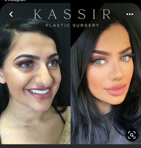 Jaw Reduction Surgery, Nose Plastic Surgery, Celebrity Relationships, Plastic Surgery Fail, Rhinoplasty Nose Jobs, Plastic Surgery Gone Wrong, Face Surgery, Rhinoplasty Before And After, Big Nose Beauty