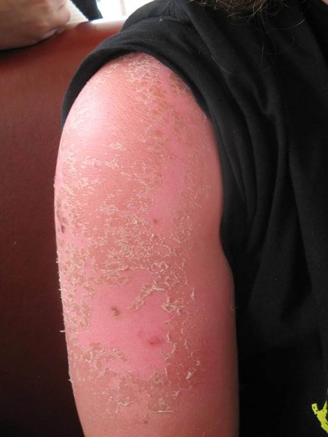 Sunburns can be uncomfortable, especially more serious burns. There's more to sun protection than sunscreen, though. Here are 5 tips for avoiding sunburns apart from sunscreen. Get Rid Of Sunburn, Sunburn Remedies, Sunburn Relief, Laser Lipo, Sun Burn, Skin Burns, Peeling Skin, Hair Skin Nails, Itchy Skin