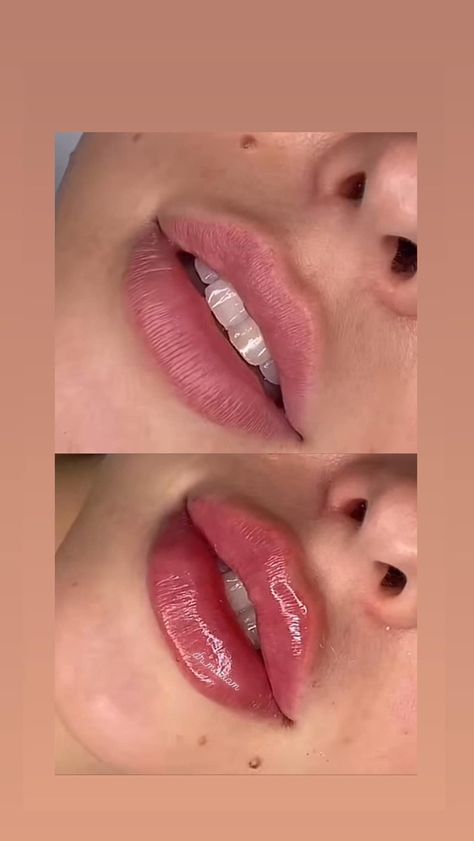 Lip Filler Round Lips, Lip Fillers Inspiration, Juvederm Before And After Lips, 1 Ml Lip Filler Before And After, Pouty Lip Filler, Fillers Before And After, Russian Lips Filler, 0.5 Ml Lip Filler Before And After, Lip Filler Shape Ideas