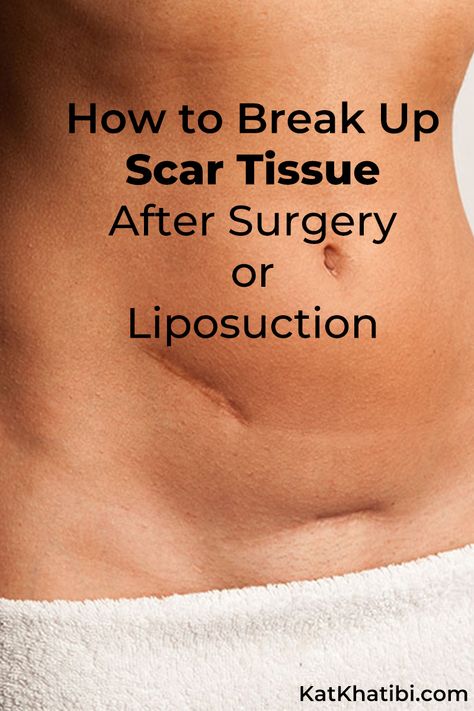 How To Break Up Scar Tissue After Surgery or Liposuction - Kat Khatibi Podcast and Wellness Blog [Health - Happiness - Beauty] Scar Tissue Removal, How To Draw Scars, Scar Tissue Massage, Plastic Surgery Recovery, Scar Massage, How To Break Up, Oils For Scars, C Section Scars, Plastic Surgery Procedures