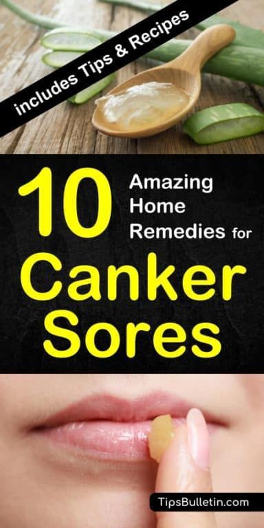 How To Heal A Canker Sore Fast, How To Get Rid Of Canker Sore In Mouth, Mouth Sore Remedy How To Get Rid, Cold Sore Remedy Fast, Canker Sore On Tongue, Canker Sore Relief, Canker Sore Remedy, Tongue Sores, Medical Tips