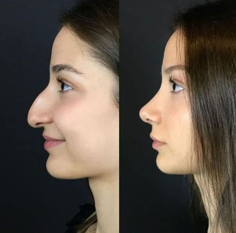 Bad Nose Jobs, Nose Surgery Rhinoplasty, Ethnic Rhinoplasty, Nose Fillers, Hooked Nose, Plastic Surgery Fail, Rhinoplasty Nose Jobs, Face Surgery, Plastic Surgery Gone Wrong