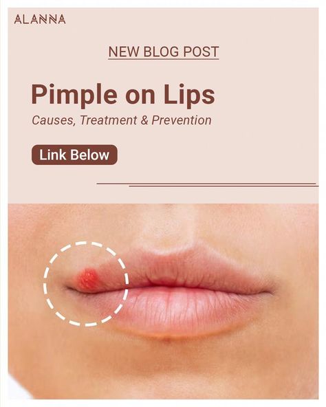 Pimple Chart, Pimples Around Lips, Pimples On Lip Line, How To Hide Pimples, Blister On Lip, What Causes Pimples, Lip Pimple, Zit Remedy, Inflamed Pimple