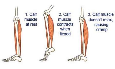 Why You Get Charley Horses and How to Stop Them / some reasons: Dehydration Mineral deficiencies Poor circulation Poor nutrition Leg Cramps At Night, Calf Cramps, Charlie Horse, Calf Exercises, Muscle Cramps, Leg Cramps, Poor Circulation, Shin Splints, Muscle Spasms