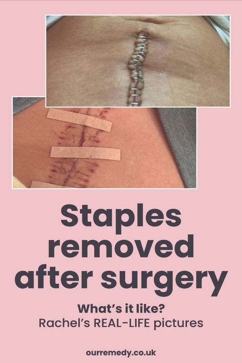 Staples Removed After Surgery Body Plastic Surgery, Pimple Marks, How To Reduce Pimples, Abdominal Surgery, Celebrity Plastic Surgery, Surgery Recovery, After Surgery, Post Surgery, Smoother Skin