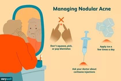 Nodule Acne, Nodular Acne, Inflamed Pimple, Back Acne Remedies, Inflammatory Acne, Blind Pimple, How To Help Nausea, Pimples Under The Skin, Pimples Overnight