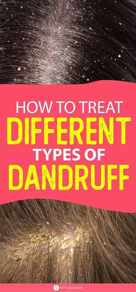 HOW TO TREAT DIFFERENT TYPES OF DANDRUFF AT HOME Bad Dandruff, Severe Dandruff, Dandruff Causes, Dandruff Solutions, How To Treat Dandruff, Home Remedies For Dandruff, Back Acne Remedies, Dandruff Flakes, Dandruff Remedy