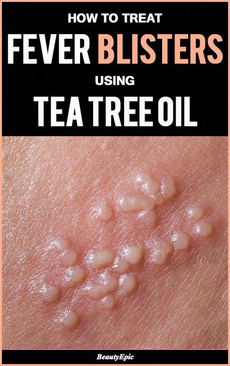 Simple Methods Of Using Tea Tree Oil for Fever Blisters #coconutoilfordarkspots Castor Oil For Acne, Tea Tree Oil Benefits, Tea Tree Oil Uses, Tea Tree Oil Face, Oils For Dandruff, Tea Tree Oil For Acne, Fever Blister, Cold Sores, Essential Oils For Headaches