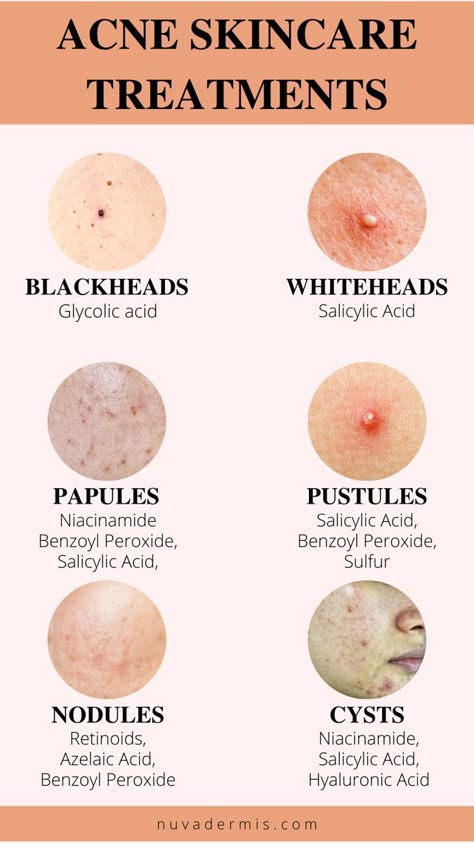 The Ultimate Guide to Acne (With Pictures) & How to Treat At Home Haut Routine, Coffee Face Mask, Face Care Tips, Natural Skin Care Remedies, Natural Acne, Good Skin Tips, How To Get Rid Of Pimples, Acne Solutions, Facial Skin Care Routine