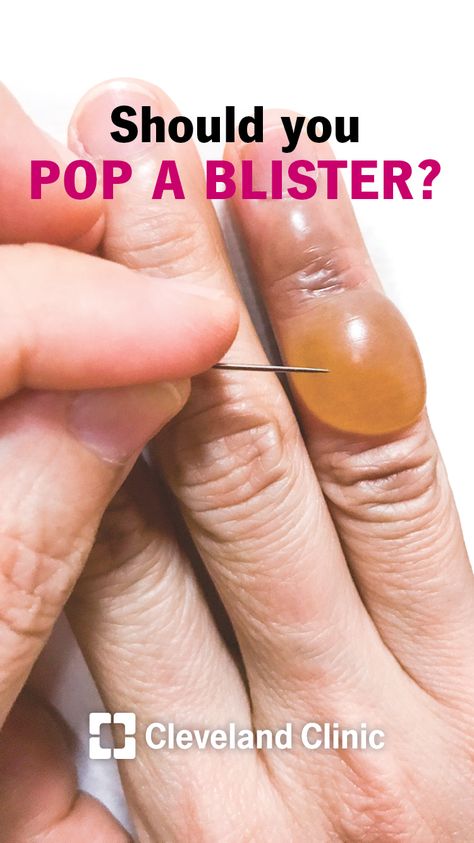 Should you pop or break a blister? Blister In Mouth, How To Treat Blisters, Water Blister, Sunburn Blisters, Blister Remedies, Blister On Lip, How To Heal Blisters, Blister Care, Blood Blister