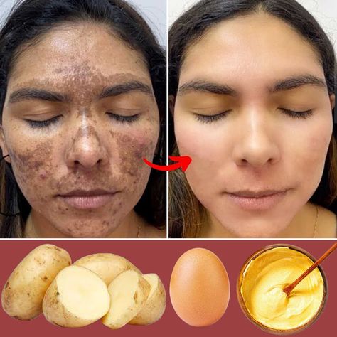 Potato Face Mask, Potato Face, Natural Skin Care Ingredients, Skin Face Mask, Dark Spots On Face, Natural Skin Care Remedies, Diy Skin Care Routine, Skin Renewal, Natural Face Skin Care