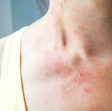 skin rash on chest Skin Rashes Pictures, Common Skin Rashes, Makeup Tips For Blue Eyes, Itchy Rash, Home Remedies For Skin, Skin Rashes, Bug Bites, Skin Diseases, Skin Discoloration