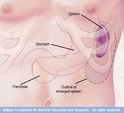 Image of enlarged spleen yes i be in discomfort hi at al hernia.. Fib ..with this to boot or just combatant injuries.......... Spleen Pain, Forward Head Posture Exercises, Low Platelets, Medicine Notes, Symptom Tracker, Upper Back Pain, Cupping Therapy, Mayo Clinic, Medical Education