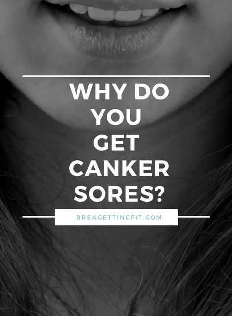 Sore In Mouth Remedies, Blister In Mouth, Canker Sore On Tongue, Canker Sore Causes, Gum Sores, Canker Sore Relief, Mouth Blisters, Ulcer Remedies Mouth, Canker Sore Remedy