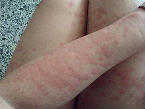 What do bed bugs, tick bites and mosquito bites all have in common? For the most part, they all leave some types of rashes of some kind that shouldn't be Heat Rash Remedy, Skin Rashes Pictures, They All Leave, Prickly Heat Rash, Leg Rash, Body Rash, Rash On Face, Rashes Remedies, Types Of Rashes