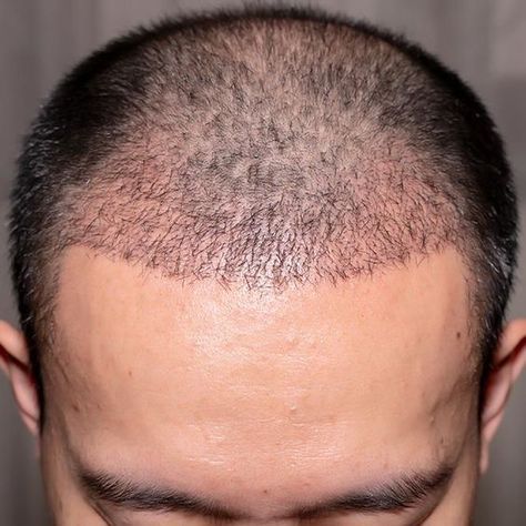 fue hair transplant Hair Stripping, Hair Implants, Hair Transplant Cost, Hair Transplant Procedure, Best Hair Care, Fue Hair Transplant, Hair Transplant Surgery, Male Celebrity, Best Hair Transplant