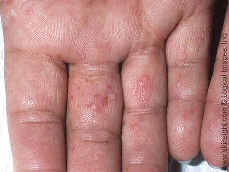 Dr. Joel Schlessinger discusses itchy, small blisters on fingers with ScarySymptoms.com Rash On Hands, Itchy Hands, Itchy Rash, Skin Disorders, Nature Pictures, Left Hand, Tampa, Hair Hair, Skin Care