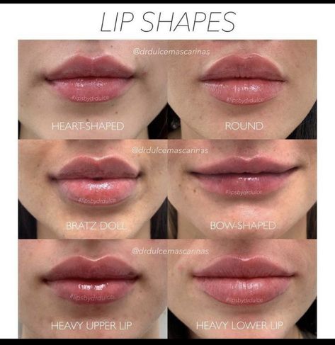 Lip Fillers Juvederm, Dermal Fillers Lips, Lips Inspiration, Lip Types, Face Fillers, Botox Lips, Being Unique, Facial Fillers, Facial Contouring