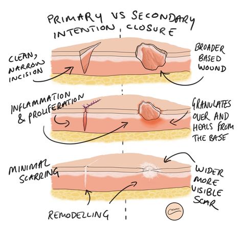 Wound Healing Nursing, Mortuary School, Nursing Facts, Wound Care Nursing, Nursing Instructor, Np School, Myofunctional Therapy, Skin Anatomy, Nursing Assessment