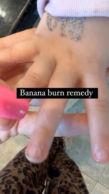 Jamie Lee on Instagram: "BURN REMEDY #burn #banana #holistichealth #holisticremedies #heal #toddlerlife #toddlermom #crunchy #crunchymomma" Burn Remedies, Home Remedies For Burns, Burned Finger, Burn Remedy, Burn Relief, Good Burns, Probiotic Foods, Hygiene Routine, Holistic Remedies