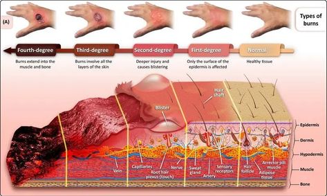 Burn Wound Care, Burns Nursing, Burn Wound, Types Of Burns, Radiation Burn, Wound Care Nursing, All Body Systems, Burn Injury, Nursing Diagnosis