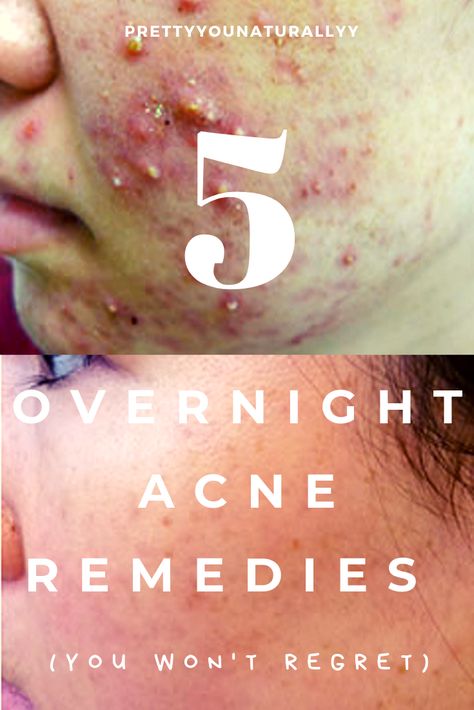 Clear Acne Overnight, Back Acne Remedies, Overnight Acne Remedies, Acne Clearing, Forehead Acne, Bad Acne, Acne Overnight, Pimples Overnight, Pimples Remedies