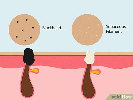 How to Get Rid of Sebaceous Filaments: 7 Effective Methods Sebatious Filaments, How To Get Rid Of Sebaceous Filaments, Sebaceous Filaments Removal, Sebum Removal, Sebaceous Filaments, Salicylic Acid Cleanser, Get Rid Of Blackheads, Harvard Medical School, Retinol Serum