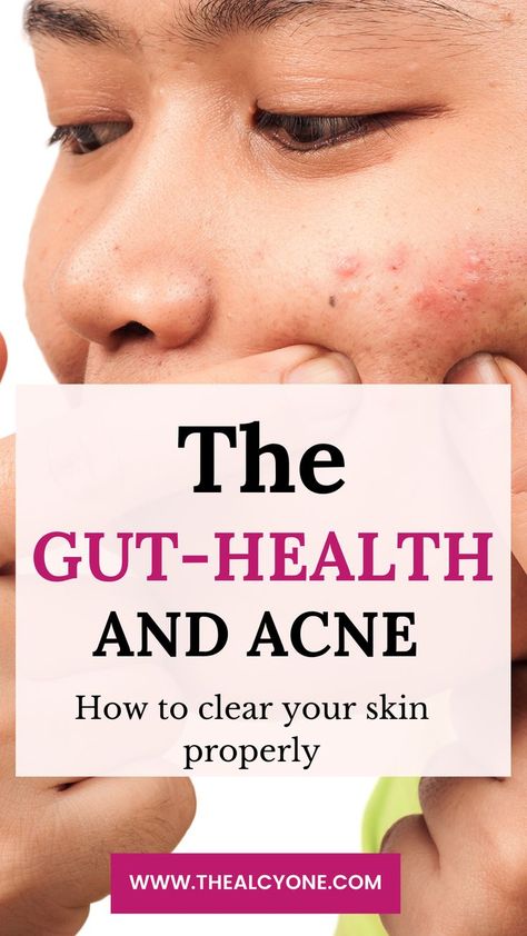 Back Acne Remedies, Acne Diet, Forehead Acne, How To Get Rid Of Pimples, Skin Detox, Hormonal Acne, Acne Remedies, How To Get Rid Of Acne, Health Skin Care