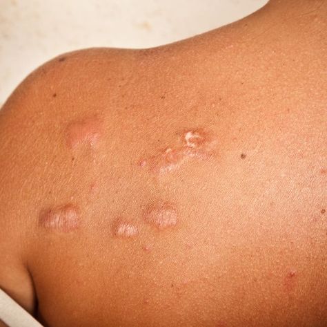 Keloid scar Back Acne Scar Removal, How To Remove Keloids Naturally, Natural Remedies For Keloids, Natural Acne Scar Remedy, Body Acne Scar Remedies, Laser Acne Scar Removal, Getting Rid Of Scars, Hypertrophic Scars, Facial Scars