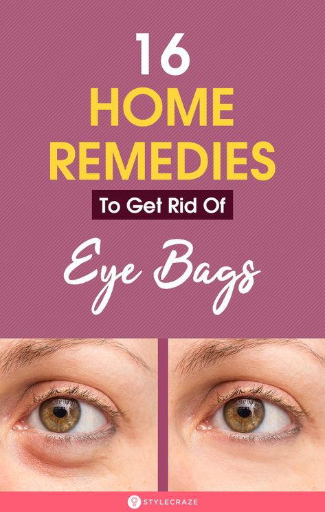 Undereye Bags Remedy, Eye Bag Remedies, Get Rid Of Eye Bags, Rid Of Eye Bags, Puffy Eyes Remedy, Baggy Eyes, Eye Bag, Cucumber Slices, Under Eyes