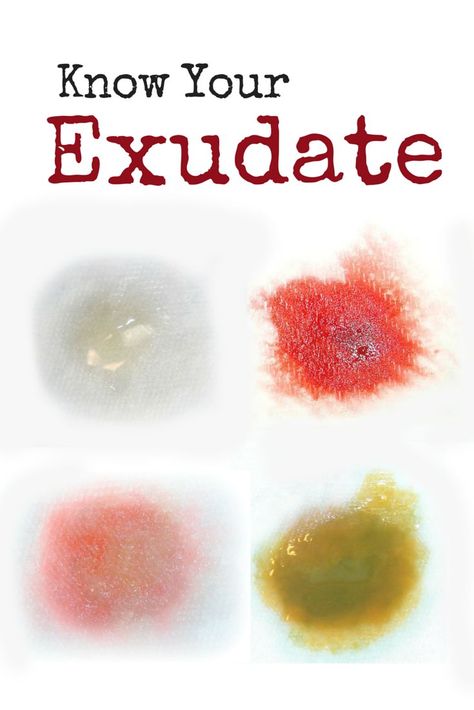 Exudate: The Type and Amount Is Telling You Something. Wound care clinicians… Nutrition Nursing, Career And Technical Education, Wound Care Nursing, Wound Care Dressings, Home Health Nurse, Nursing School Prerequisites, Nursing Cheat, Nursing Board, Med Surg Nursing