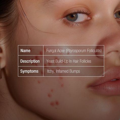 Acne Skincare, Types Of Acne, Skin Science, Clearer Skin, Hair Follicle, Skin Care Acne, What Type, Skin Health, Different Types