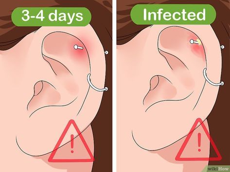 Cartilage Piercing Infection, Infected Ear Piercing, Cartilage Piercing Care, Helix Piercing Pain, Cleaning Piercings, Upper Ear Piercing, Double Cartilage Piercing, Cool Ear Piercings, Cartilage Piercings