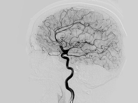 Cerebral angiography is a test to find blockages in the blood vessels of your head and neck. Learn about the procedure, risks, and more. Neuroscience Art, Brain Drawing, Med School Motivation, Brain Art, Medicine Student, Neurology, Radiology, Anatomy Art, Human Anatomy