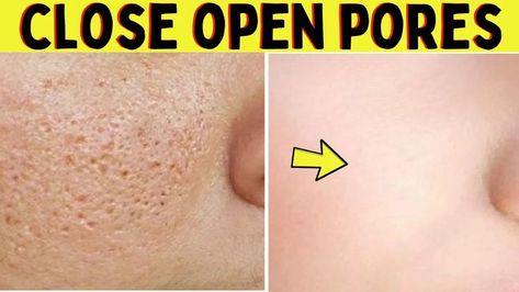 In this video, I will tell you how to close open pores on face permanently naturally at home. In just 3 days you can fill open pores on your face. These are several ways to shrink large pores on the face but natural home remedies have no side effect on your skin. For this reason, I'll highly recommend you to try natural home remedies to reduce open pores on your face. How To Reduce Large Pores On Face, Reduce Open Pores On Face, Remedies For Open Pores On Face, How To Close Pores On Face, How To Reduce Pores On Face, How To Close Open Pores On Face, How To Remove Pores, How To Close Pores, Open Pores On Face