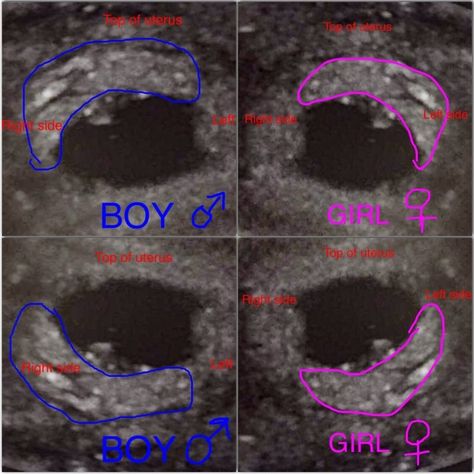 The Basics of The Ramzi Theory “Ramzi’s method is using placenta/chorionic villi location as a marker for fetal gender detection at 6 weeks gestation was found to be highly reliable. This method correctly predicts the fetus gender in 97.2% of males and 97.5% of females early in the first trimester.” The Gender Experts encourage anyone who is interested in this … Ramzi Theory, Pregnancy Gender Prediction, Ultrasound Gender, Gender Predictor, 5 Weeks Pregnant, Baby Gender Prediction, Pregnancy Gender, Gender Prediction, Early Pregnancy Signs