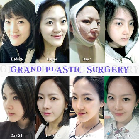 Create a slender jaw line and youthful appearance with Grand. Grand's two jaw surgery enables you become beautiful in a safe way. For free consultation Tel: (+82) 70-7119-1580 Mobile: (+82) 10-7156-6546(Whatsapp, Line, Kakaotalk, Viber, iMessage) Email: grandps.en@gmail.com Facebook: facebook.com/grandplasticsurgery Webstie: eng.grandsurgery.com Pinterest : https://www.pinterest.co.kr/grandps_eng/ Tumblr: http://grandsurgery.tumblr.com/ Instagram: grandps_eng Chin Reduction Surgery, Long Chin, Chin Surgery, Chin Reduction, Plastic Surgery Korea, Bad Plastic Surgeries, Korean Plastic Surgery, Become Beautiful, Jaw Surgery