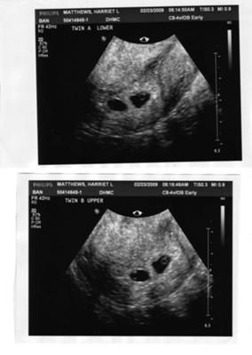 3 Weeks Pregnant Ultrasound Twins, Usg Pregnancy Twins, Twin Ultrasound 6 Weeks, Twins Manifestation, 3 Weeks Pregnant Ultrasound, 5 Week Ultrasound Pictures, 4 Weeks Pregnant Ultrasound, 7 Weeks Pregnant Ultrasound, 5 Weeks Pregnant Ultrasound