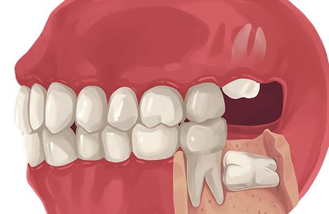 What Should You Expect From Wisdom Teeth Removal? Wisdom Teeth Recovery, Impacted Wisdom Teeth, Wisdom Teeth Pain, Teeth Surgery, Impacted Tooth, Dental Extraction, Dental Implant Procedure, Dental Decay, Wisdom Tooth Extraction