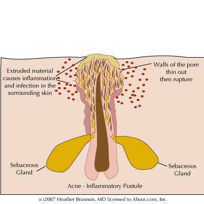 Bacterial Acne, Acne Representation, Nodular Acne, Treat Hormonal Acne, Nodule Acne, Spironolactone For Acne, Acne Meme Funny, Different Types Of Acne, Acne Vulgaris