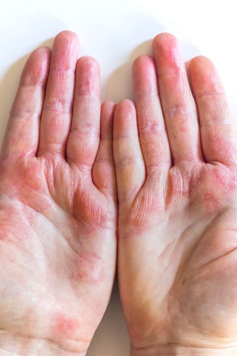 No, stress won’t exactly cause atopic dermatitis, the condition known as eczema. Learn why and read about other common misconceptions surrounding the rashlike condition. Contact Dermitis Hands, Atopic Dermitis Remedy, Rash On Hands, Arts Portfolio, Common Diseases, Heat Rash, Hand Protection, Forehead Wrinkles, Skin Condition