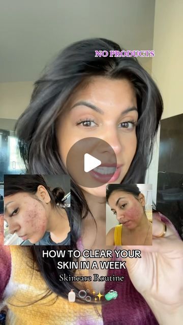 ANCI on Instagram: "I really didnt smile🤣🫶🏼👇🏼  The less you use the FASTER YOUR SKIN WILL HEAL. You will literally see your skin clear up in a week   #toxicfree #skinsta #skincareritual #skinhealth #fragrancefree #igskincare #bodyscrubs #naturalskincaretips #cleanbeauty #greenbeautyrevolution #skincareblogger #healthyskincare" How To Clear Your Skin, How To Get Clear Skin Naturally, Clear Skin Detox, Clear Skin Naturally, Skincare Blogger, Skin Clear, Beauty Remedies, Healthy Skin Care, July 25