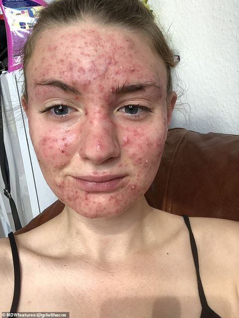 Woman, 20, who had 'never had a single pimple' until she went on the Pill claims it caused her face to break out in 'painful' cystic acne so severe that it affected her sight Skincare Jerawat, Nodular Acne, Closed Comedones, Blackhead Scrub, Pimple Extractor, Brown Spots Removal, Types Of Acne, How To Get Rid Of Pimples, Pimple Marks