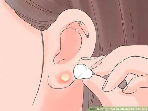 How to Treat an Infected Ear Piercing: 14 Steps (with Pictures) Ear Piercings After Care, Ear Piercing At Home, Piercing At Home, Infected Ear Piercing, Ear Piercing Care, Zit Remedy, Piercing Bump, New Ear Piercing, Getting Your Ears Pierced